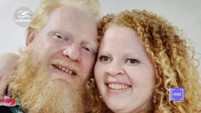 A vida de quem tem albinismo: histórias, relatos, cuidados com a saúde e projetos