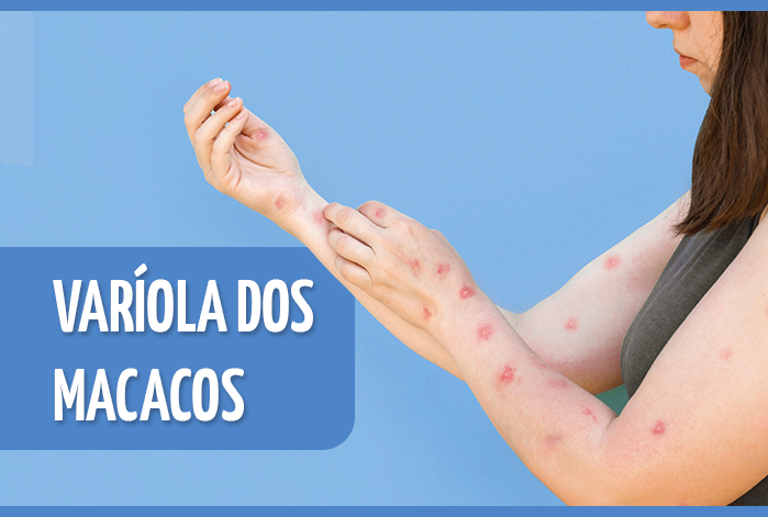 Perguntas e respostas sobre varíola dos macacos