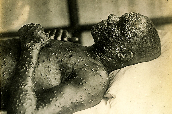 Homem com as bolhas da varíola: após campanha mundial, OMS anunciou erradicação da doença em 1980 (foto: National Museum of Health and Medicine, Otis Historical Archives)