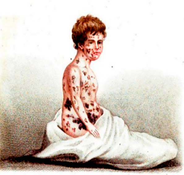 Ilustração do século 19 mostra marcas da varíola (imagem: reprodução)