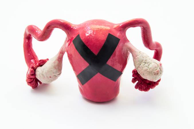 Female infertility concept. Model of female uterus with ovaries with black prohibiting cross on it. Photo symbolizing female infertility with cause of pathology of genital organs such as endometriosis