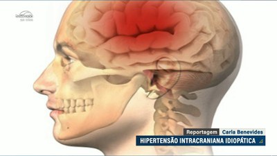 Hipertensão intracraniana idiopática deve ser reconhecida como doença rara, defendem pacientes